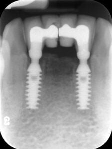 Odbudowa protetyczna 4 dolnych zębów siecznych na implantach BICON – zdjęcie RTG