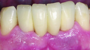 Odbudowa protetyczna 4 dolnych zębów siecznych na implantach BICON