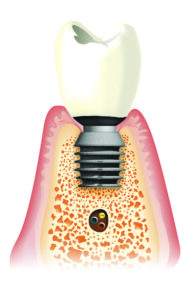 Implanty BICON dł. 5 mm nie wymagające podnoszenia dna zatoki szczękowej